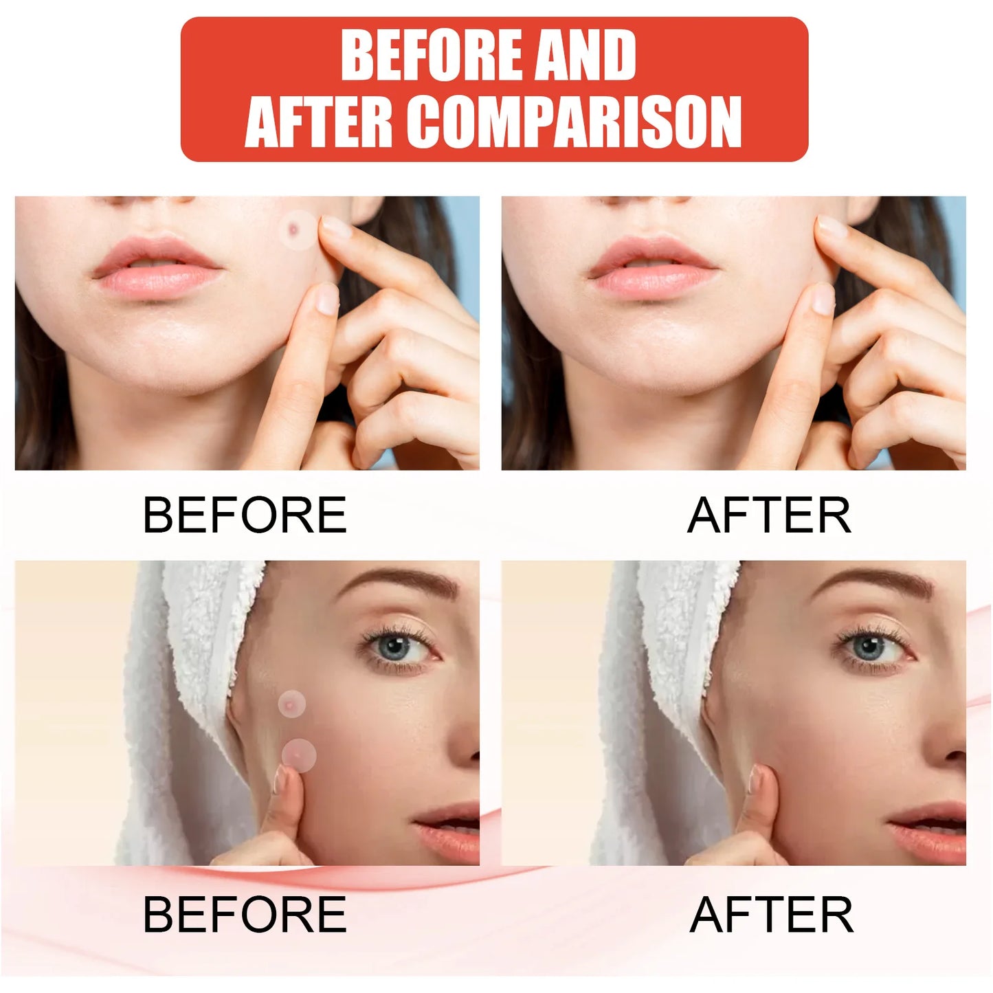 Hydrocolloid Acne Patches - Invisible Pimple Repair Patches